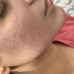 microneedling after